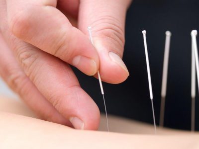 Dryneedling