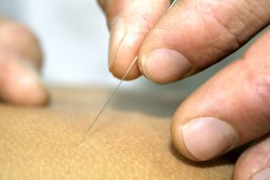 dry needling amsterdam
